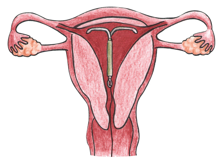 IUD Progesterone info